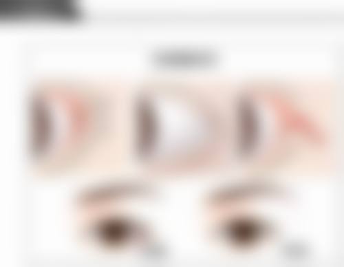 医生技术对三点定位双眼皮手术中眼睛安心性的影响