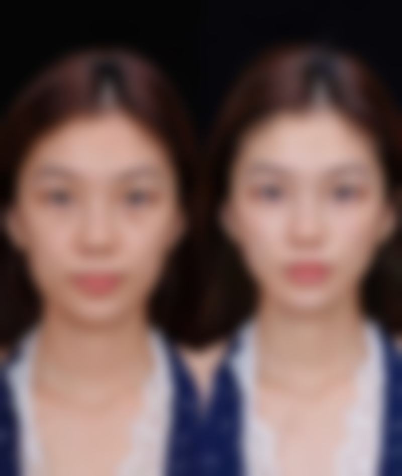 重度的眼袋怎么去：综合方案——个性化定制你的去眼袋计划