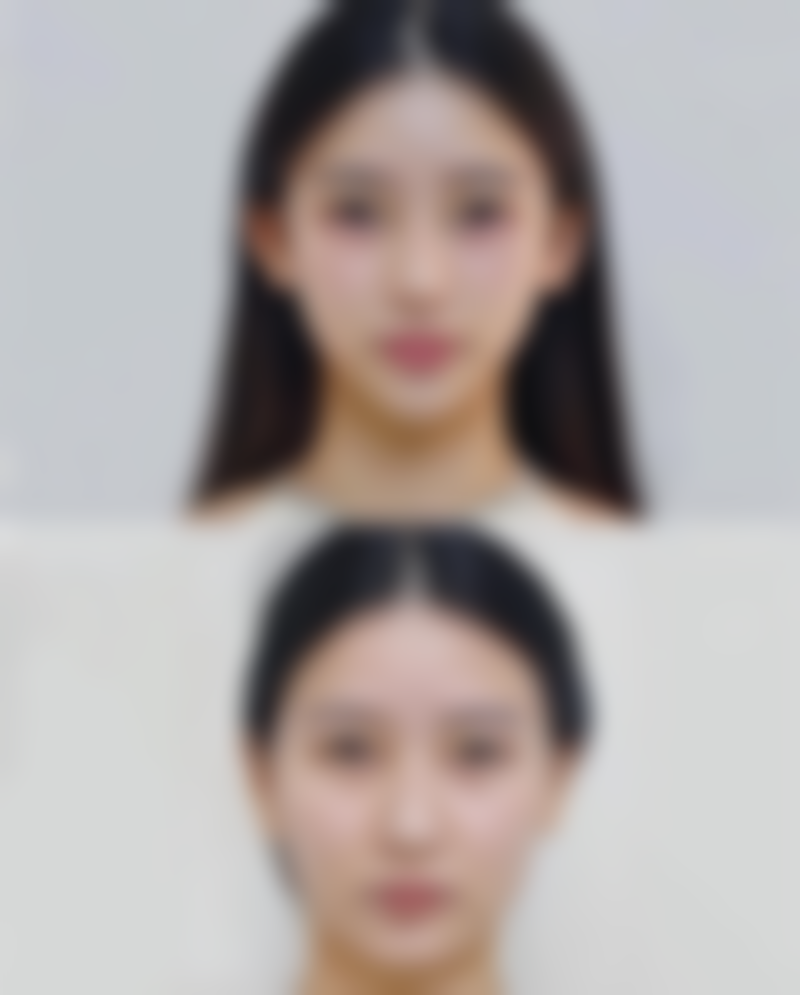 手术材料对三点定位双眼皮手术中眼睛健康的作用