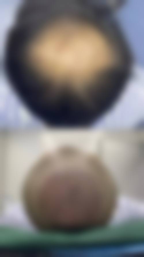 河南洛阳未毛植发是否正规