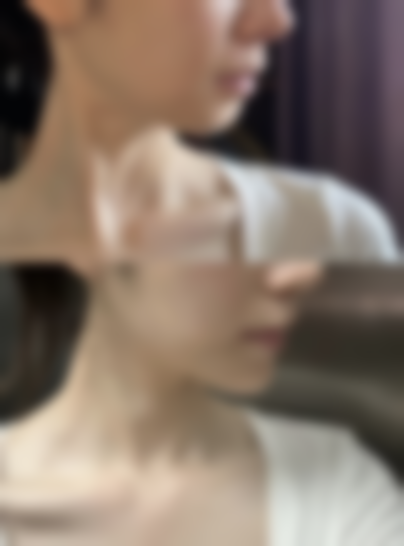 芦荟保湿凝胶对烫伤疤痕可以去除吗