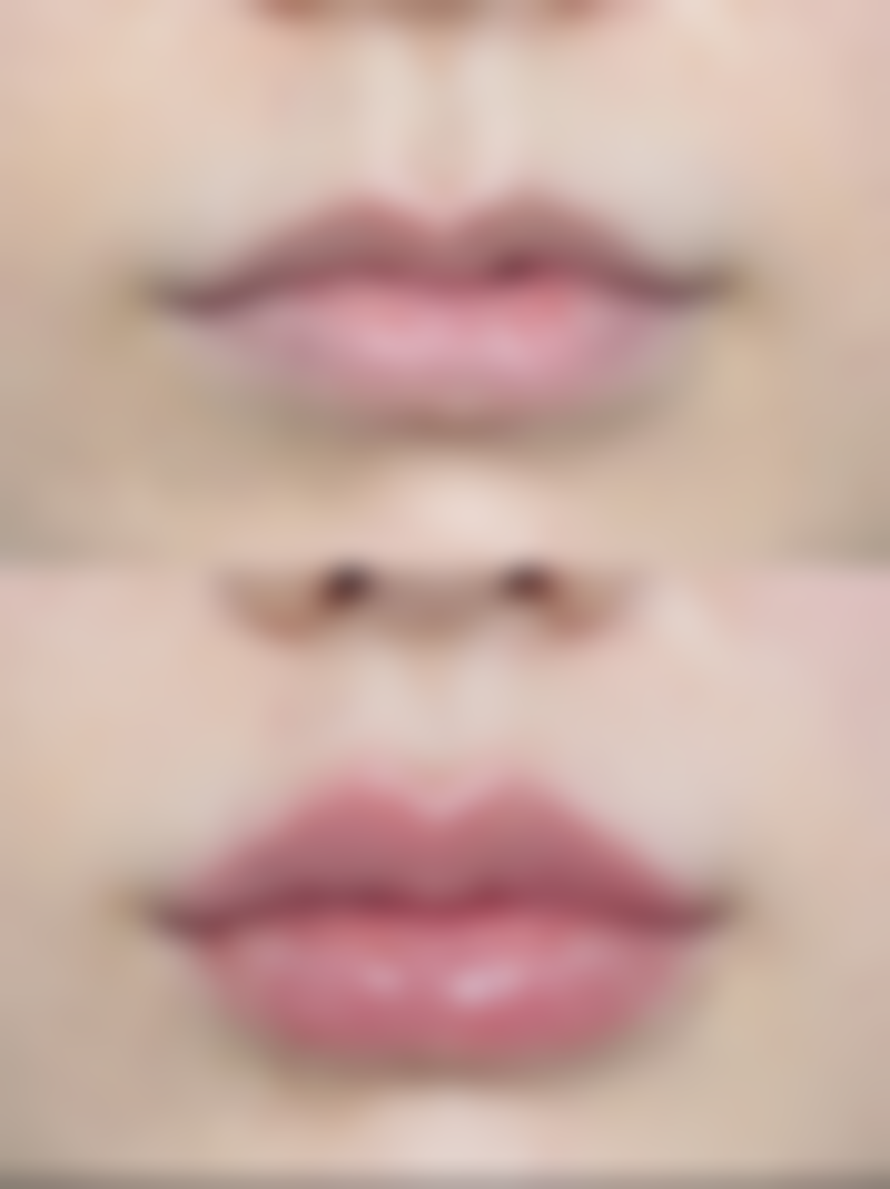 脂肪隆胸要修复多久——术后1 - 3个月脂肪稳定期进展