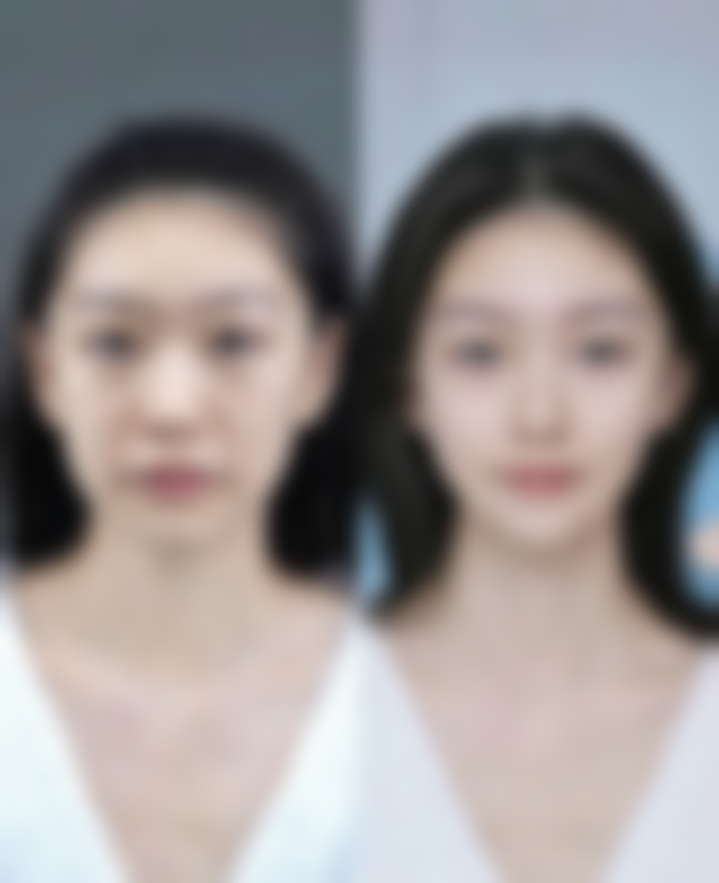 十堰医院激光祛黑印:科技美肤的神奇利器