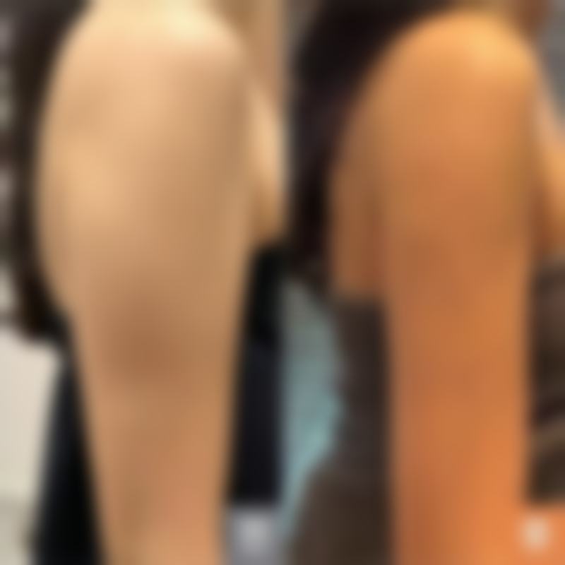 脂肪隆胸要修复多久——术后护理质量作用