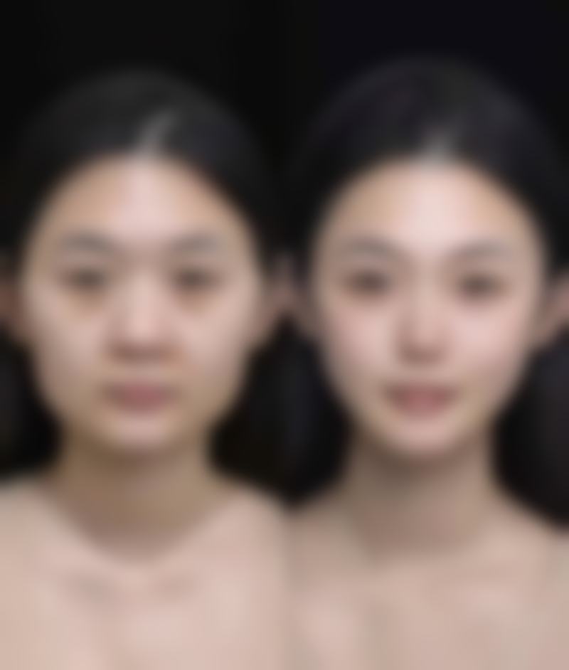 20年前埋线双眼皮不拆线的合理缘由