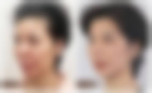 双眼皮增生用疤克去掉后会复发吗——防复发实用指南