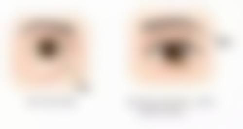 皮肤疤痕体质怎么治疗:压力疗法——温柔的持久战