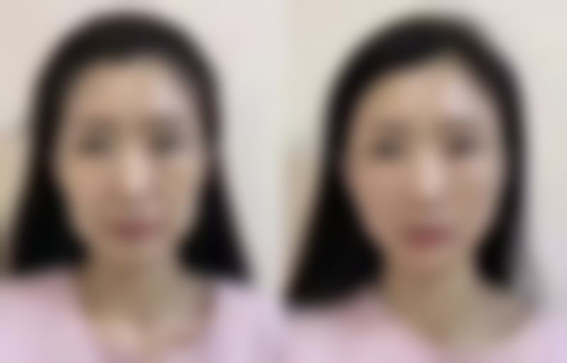 胶原蛋白去眼袋的神奇原理：一场精密的皮肤重建工程