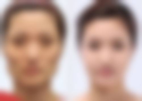 疤痕体质熬夜会加重疤痕增生吗