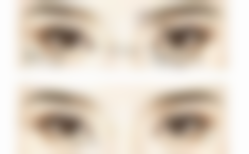 耳软骨隆鼻住院注意事项:住院期间需谨慎