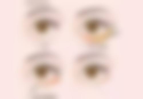 疤痕体质熬夜对皮肤有哪些影响