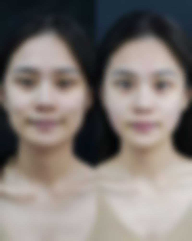 遵医嘱用药:割双眼皮后的用药指南