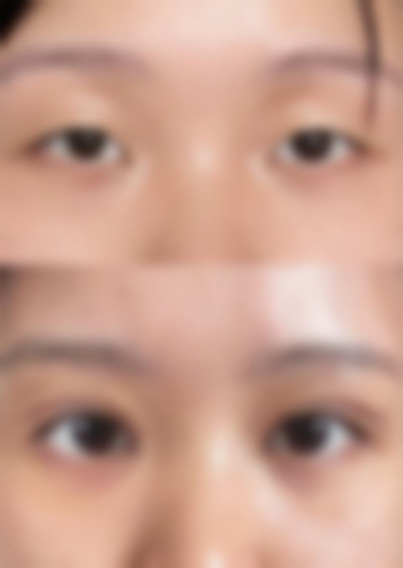 宝宝脸上的冻疮疤痕怎么去除：加速自然消退护理技巧