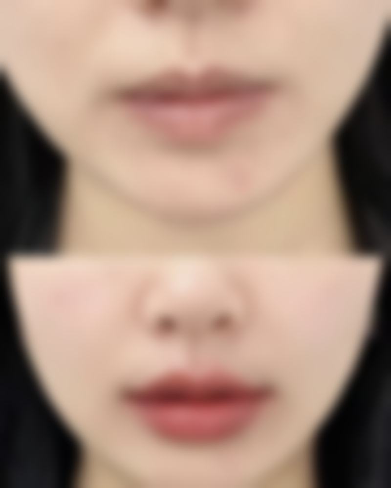 疤痕体质熬夜的注意事项