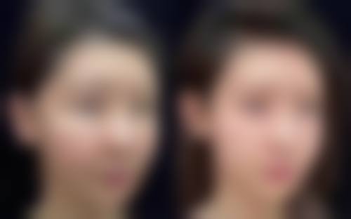 做完双眼皮一个月术后更关键的3点护理原则