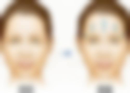 疤痕增生后黑色素沉淀自然消除时间的精细剖析