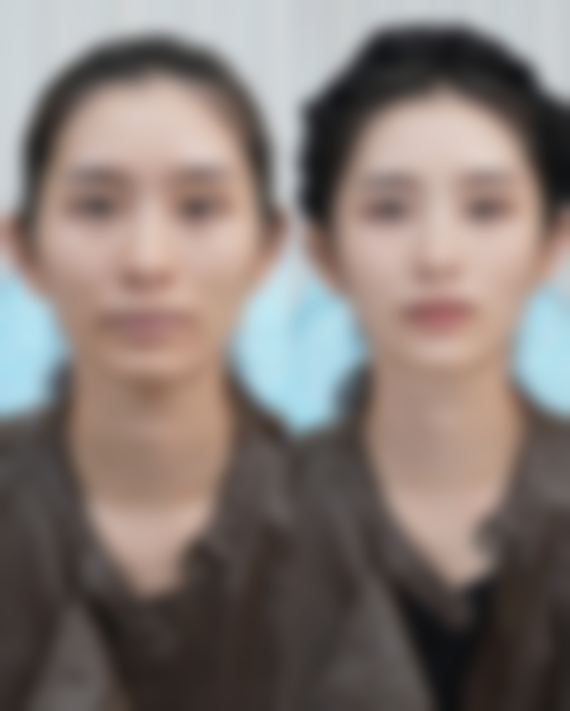 做完双眼皮一个月哭泣会导致肿胀加重吗？消肿全攻略