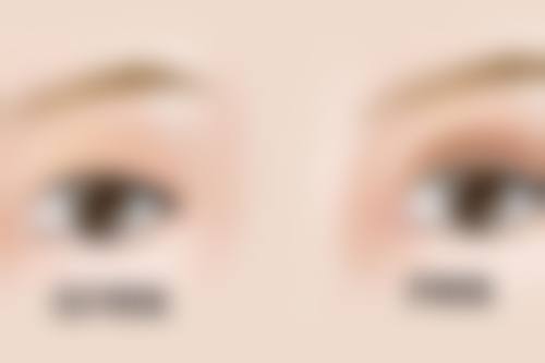 瘦脸针瘦屁股的副作用与风险