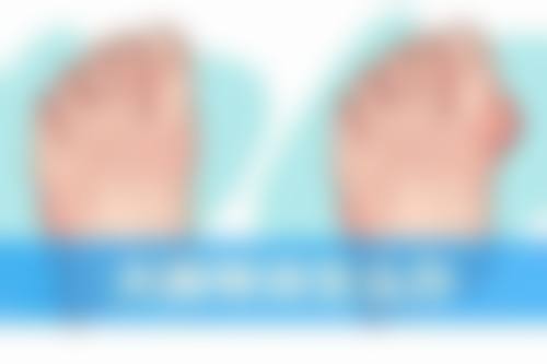 儿童缝针后的疤痕会留下怎么办之防晒护理至关重要