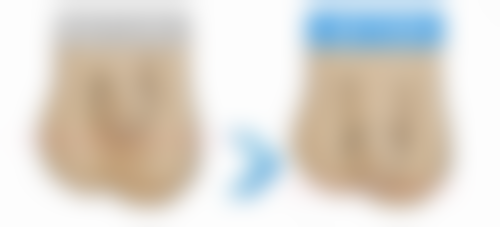 尾段：射频紧肤的正确打开方式