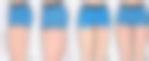 内双割双眼皮的术后修复：从“悲伤蛙”到“电眼美女”的华丽蜕变