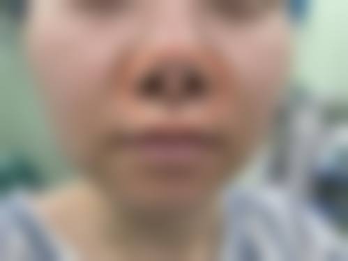 许昌正美韶华医疗整形郝文玉眼部整形的惊艳反馈