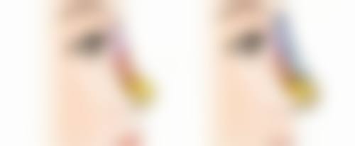 疤痕增生变软是良性变化吗