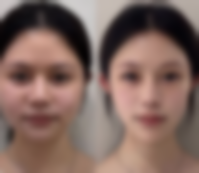 怎样去除被烫疤痕：预防胜于治疗