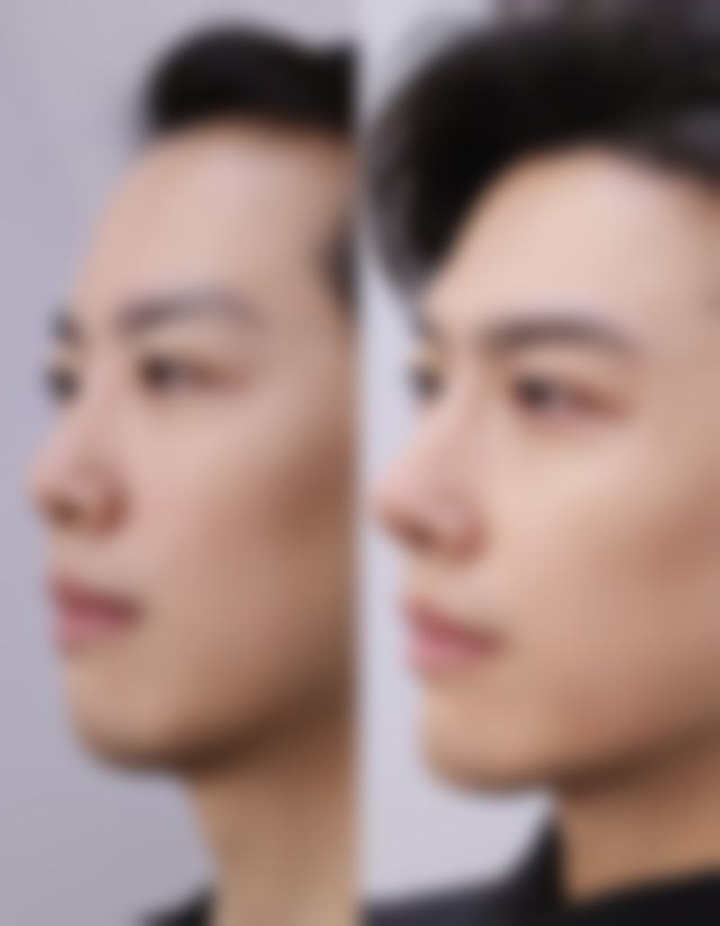 怎样清除擦伤疤痕——腿部擦伤疤痕解决方案，应对大面积挑战的法宝