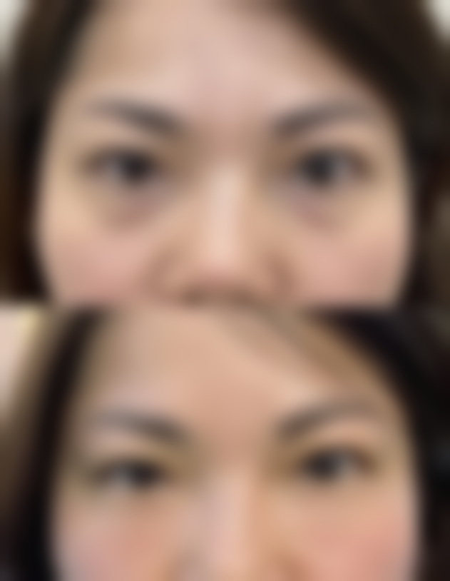 怎样去除眼袋和鱼尾纹：成都华美美天医疗美容医院光电联合治疗——全方面改善眼周老化的有效手段