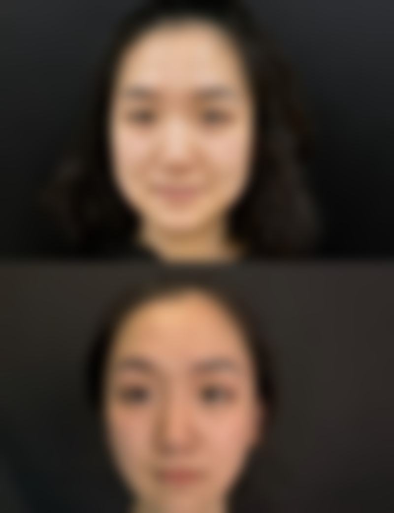 结尾：坚持就是胜利，告别疤痕拥抱美丽