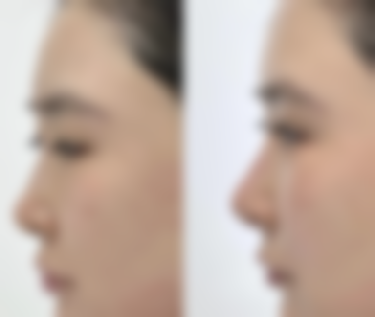 脸上凹陷疤痕涂抹祛疤膏之谢益宁实测成效