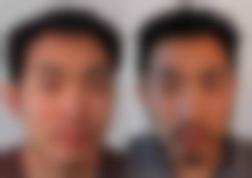 上海莱森植发门诊部怎么样——顾客实例