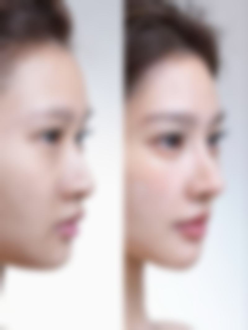 四、首次注射瘦脸针剂量指南