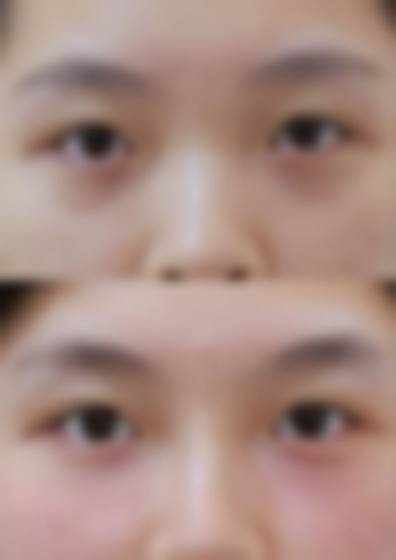 心理层面上割双眼皮期间食用蘑菇类的积极意义