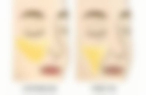 影响孩子双眼皮的因素：与手术无关