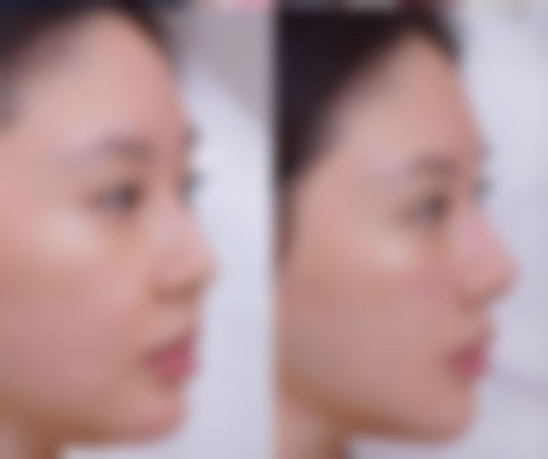 六、真实反馈：患者眼中的全切双眼皮修复体验