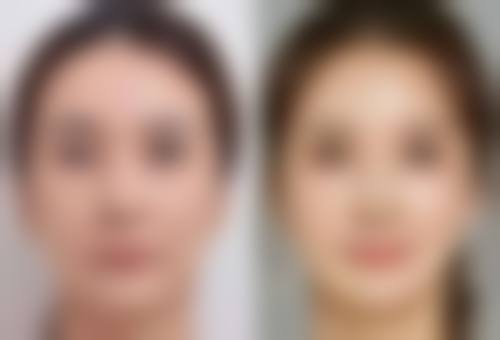 儿童烫伤增生疤痕疙瘩会自己消失吗？儿童医院医生带来好消息