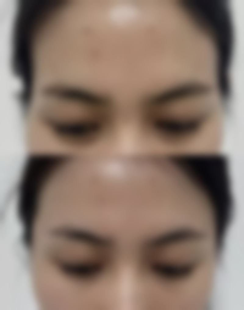 贵州省中医一附院推荐睛明穴按压改善眼周问题