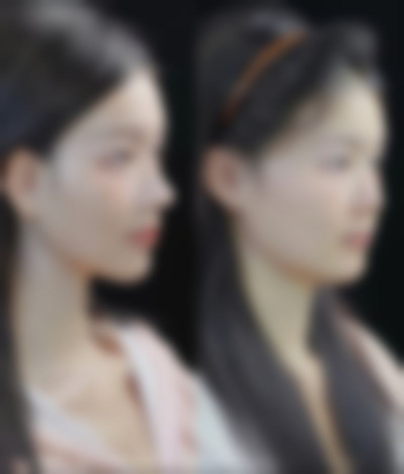 大面积vs轻微烫伤：烫伤增生疤痕疙瘩“消失”概率大不同