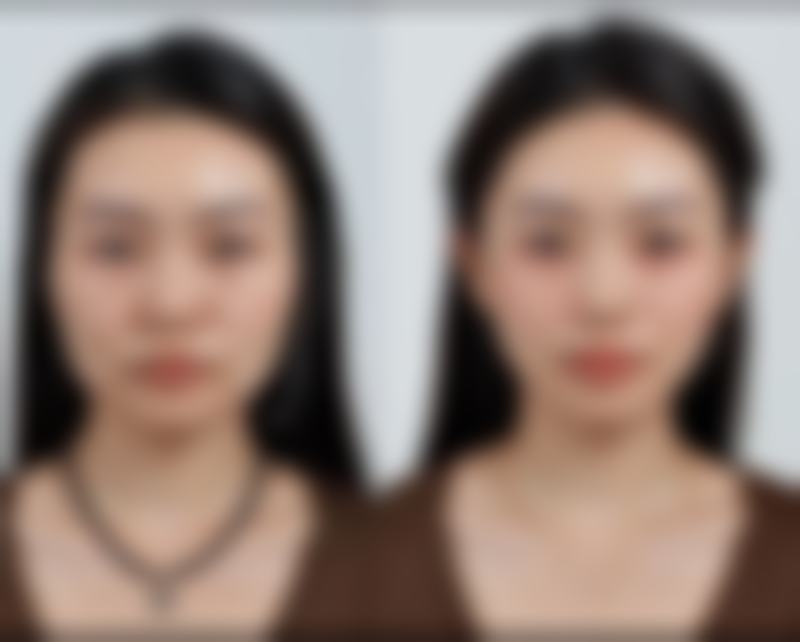 国内医学科学 院整形外科医院激光美白术：科技去黑眼圈的终极方案