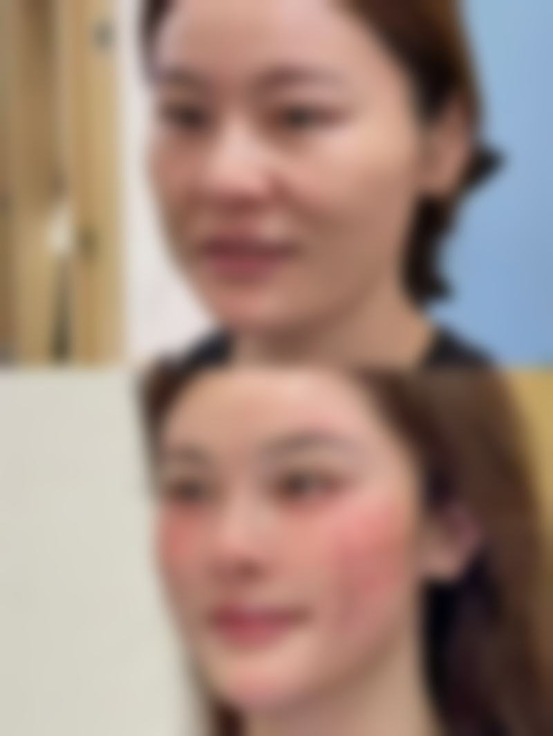 抽脂去眼袋之价格差异因素论