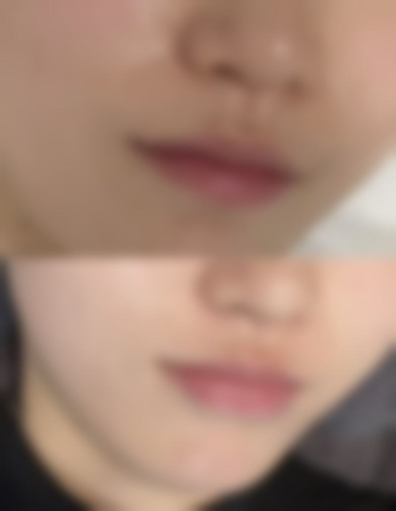 山东省立医院解析影响埋线双眼皮消失时间的三大因素