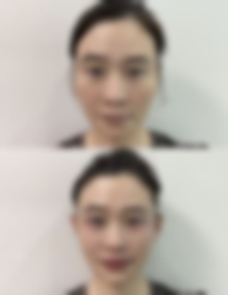 抽脂去眼袋之修复期上班族福音论