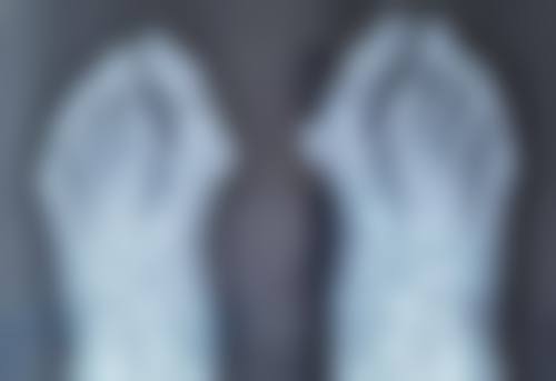 二、沈阳医院治疗摔伤疤痕色素沉着的优势