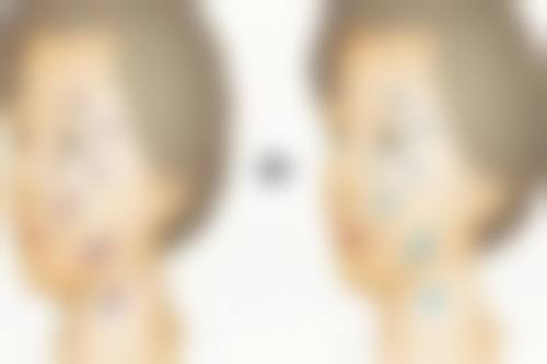 膨体隆鼻一般能管多久：15年+的持久选手