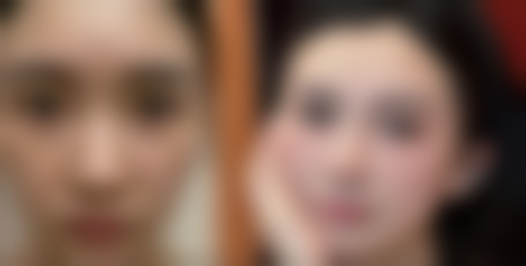 北京热玛吉眼部除皱成效好吗——三等甲医生实测数据论证