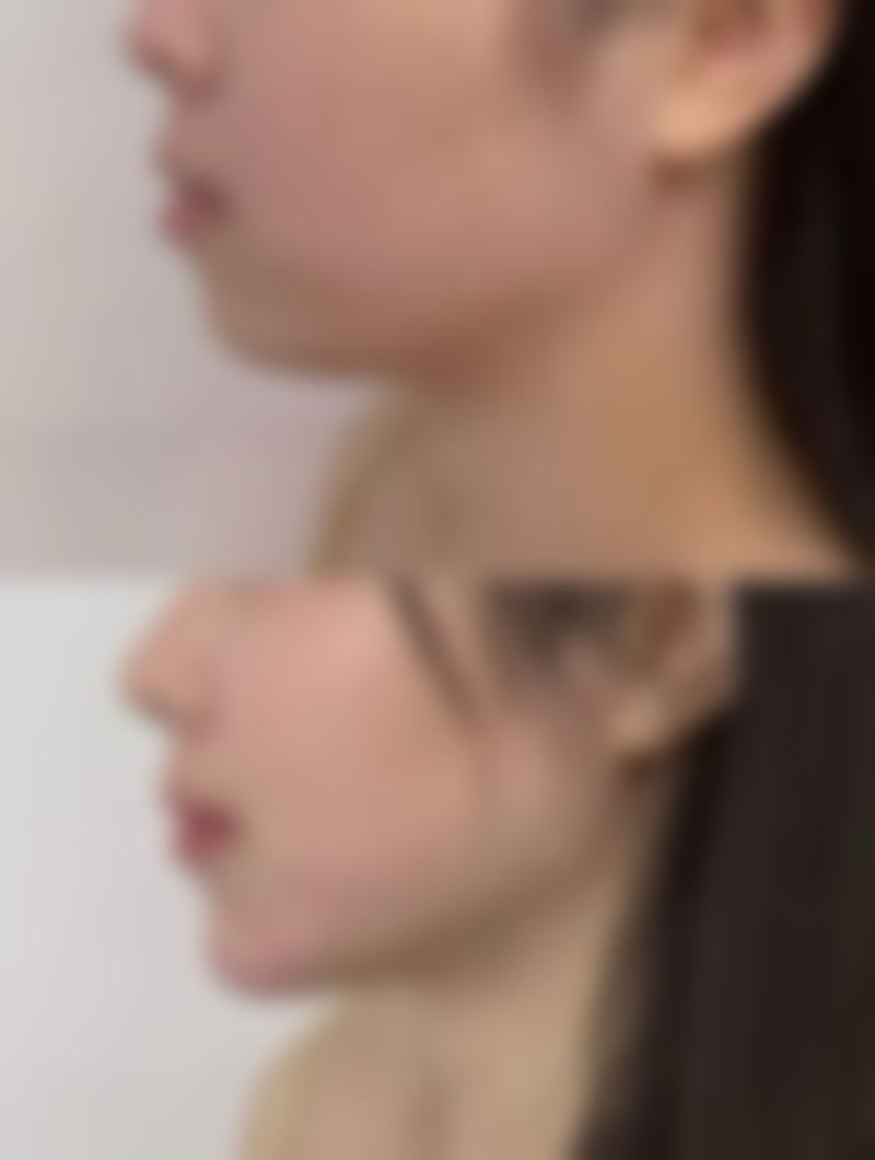 脸上有疤痕有什么办法可以修复——河北医 科 大学第三医院手术修复：重度疤痕的终极解决方案