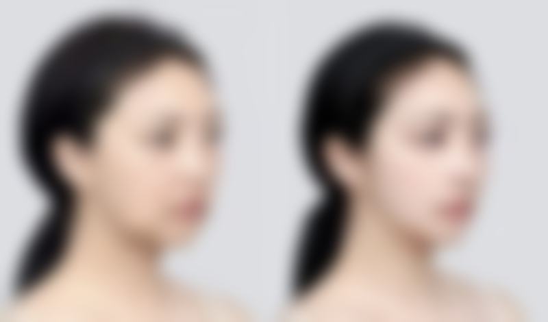 五、沈阳医院祛除摔伤疤痕色素沉着的费用指南