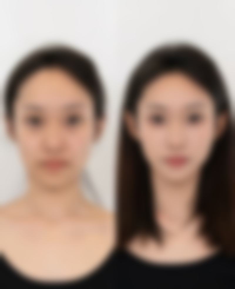 热玛吉对不同类型的眼周皱纹成效好吗——详细对比分析